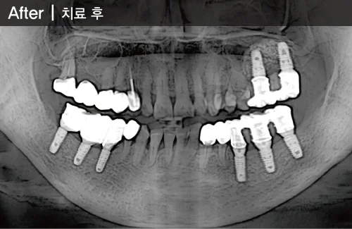 틀니는 지긋지긋해요 치료 후